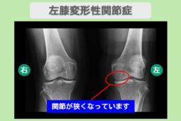 右膝変形性関節症