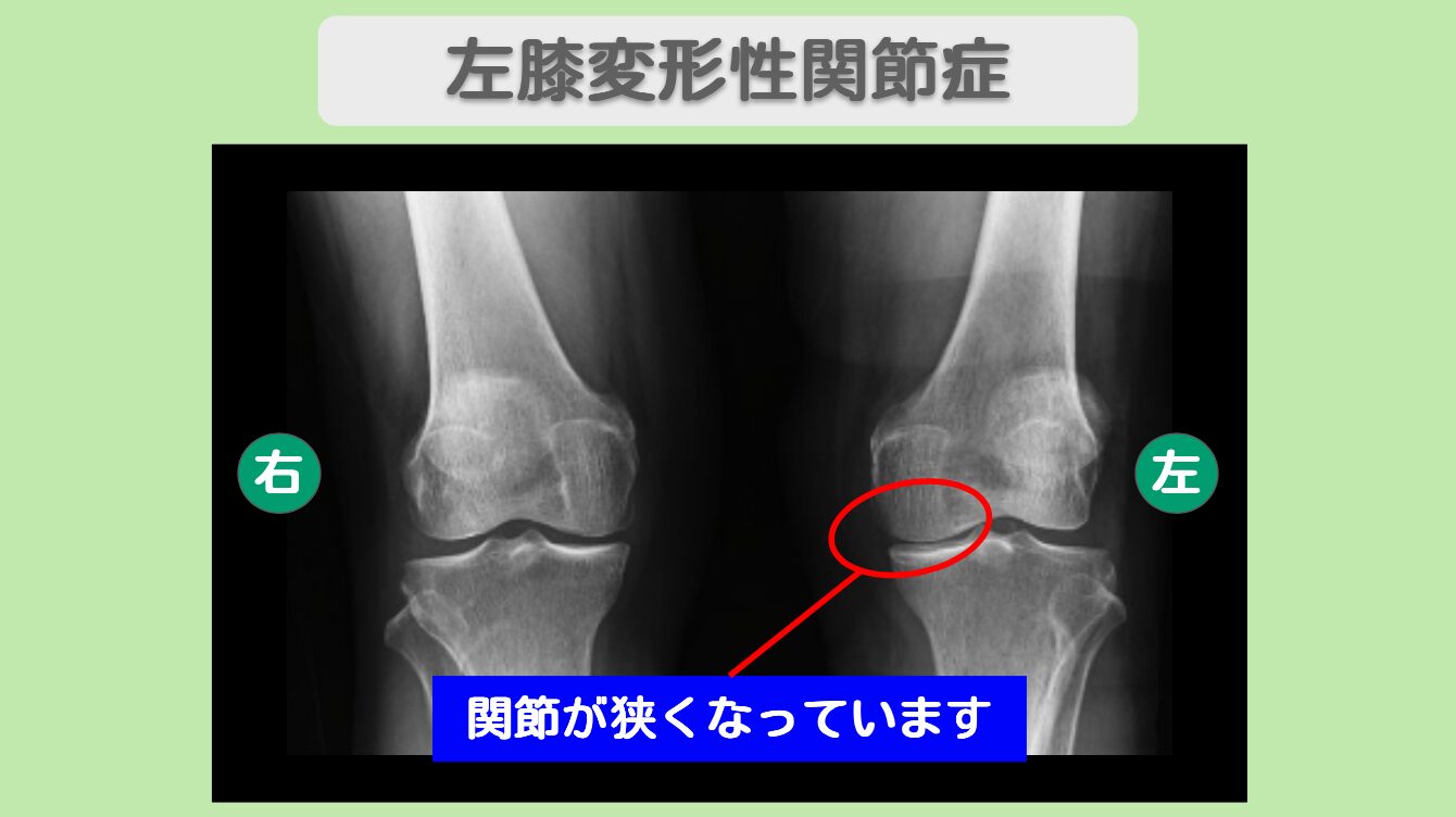 右膝変形性関節症