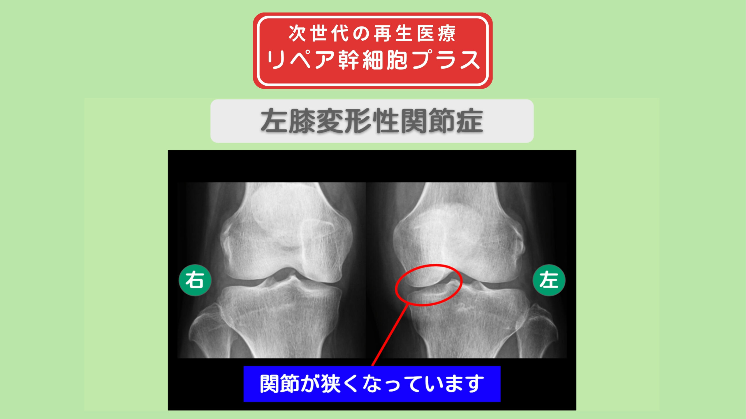 左膝変形性関節症