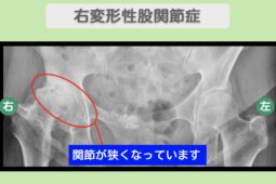 右変形性股関節症