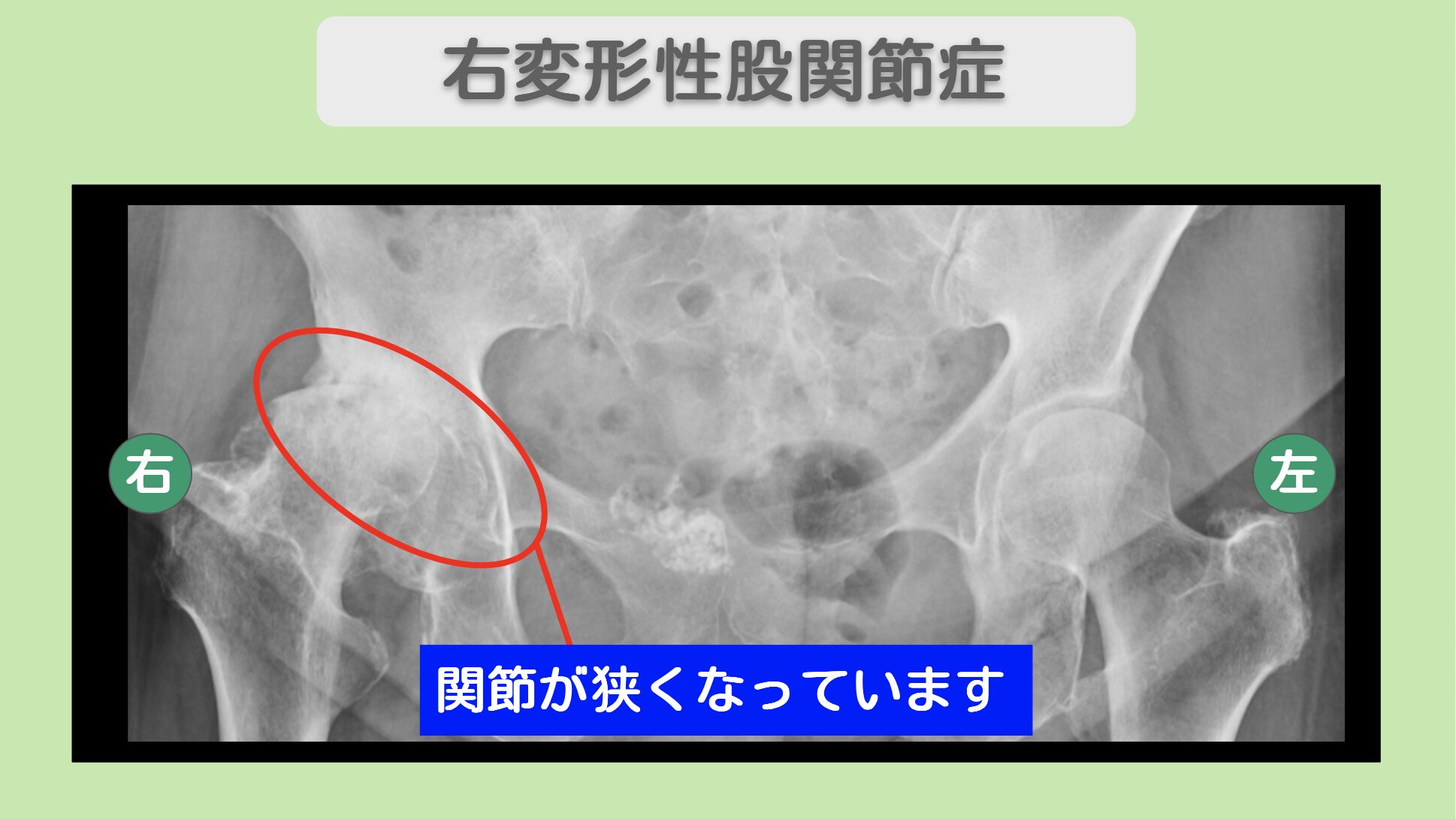 右変形性股関節症