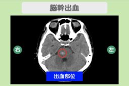 脳幹出血