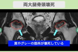 両大腿骨頭壊死