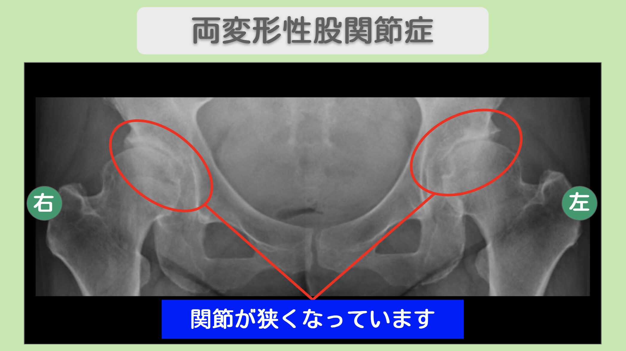 両変形性股関節症