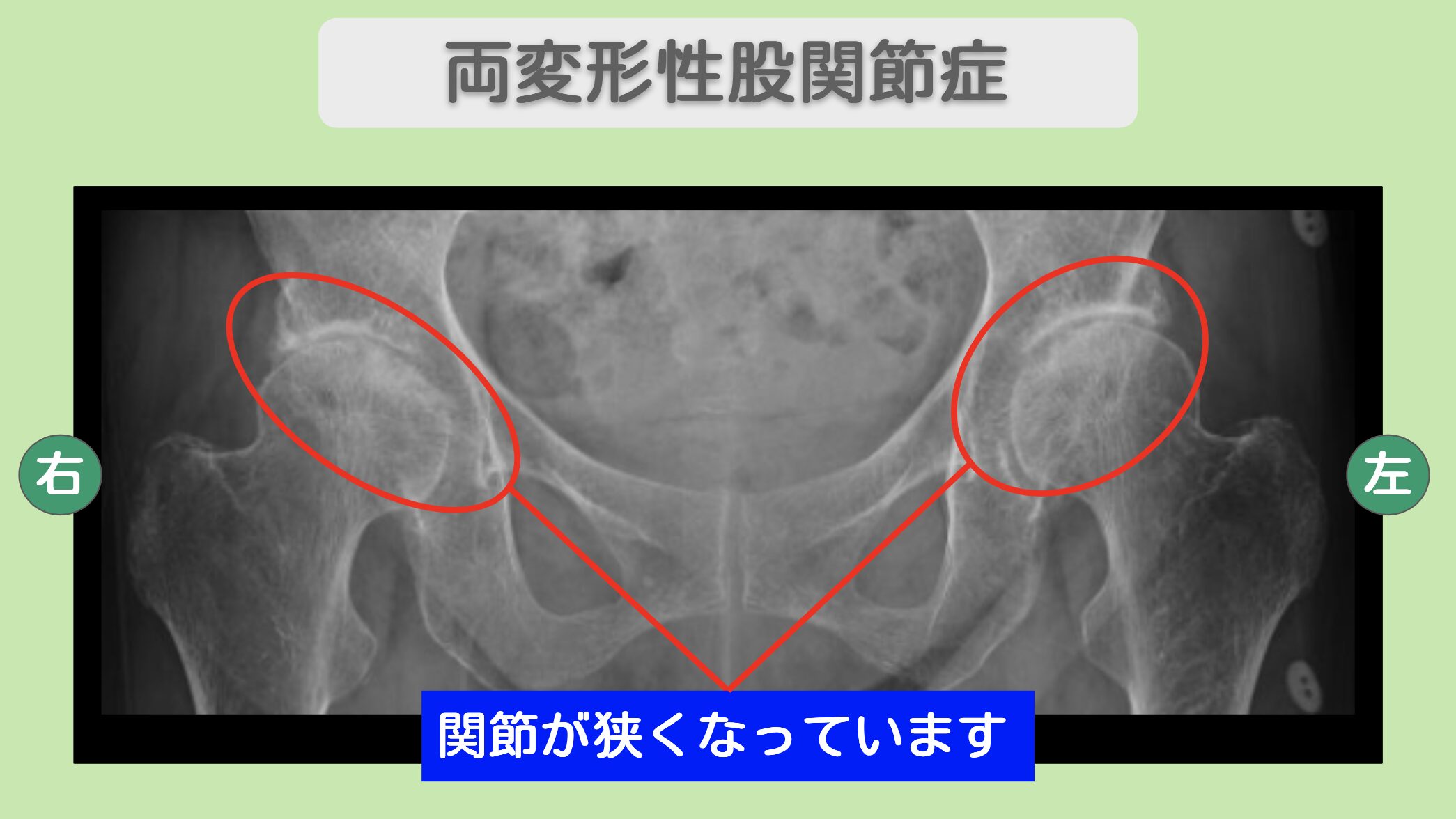 両変形性股関節症