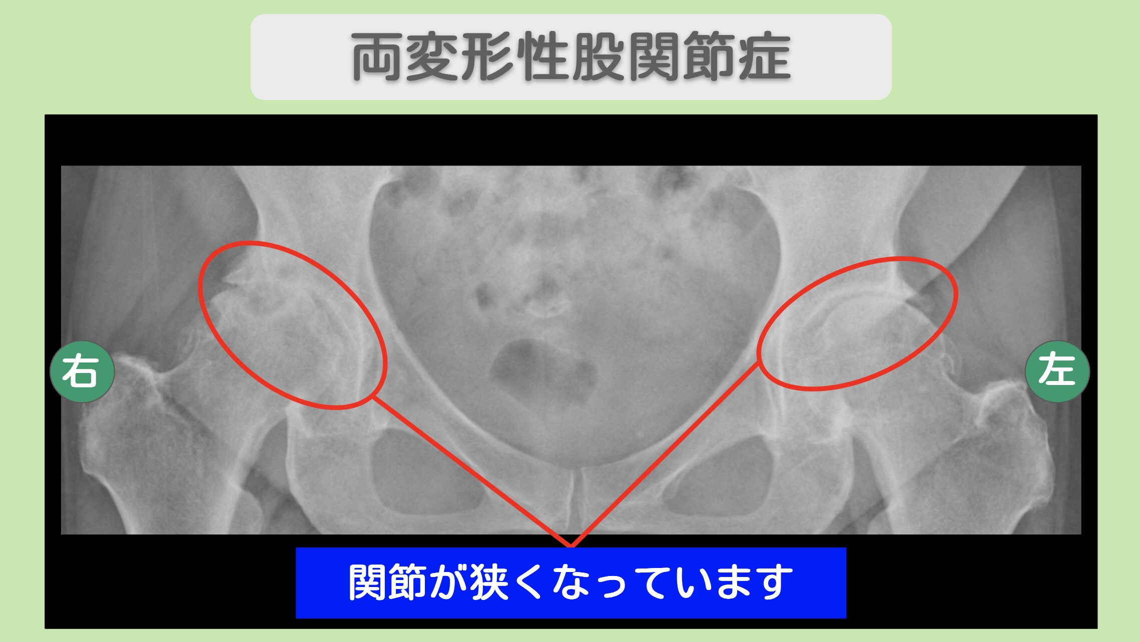 両変形性股関節症 70代女性のレントゲン所見