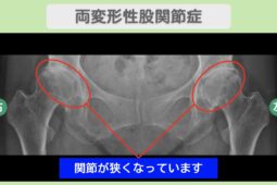 両変形性股関節症 70代女性のレントゲン所見