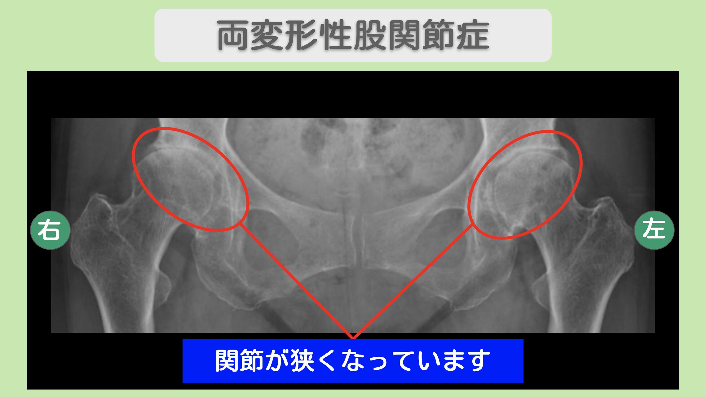 両変形性股関節症 70代女性のレントゲン所見