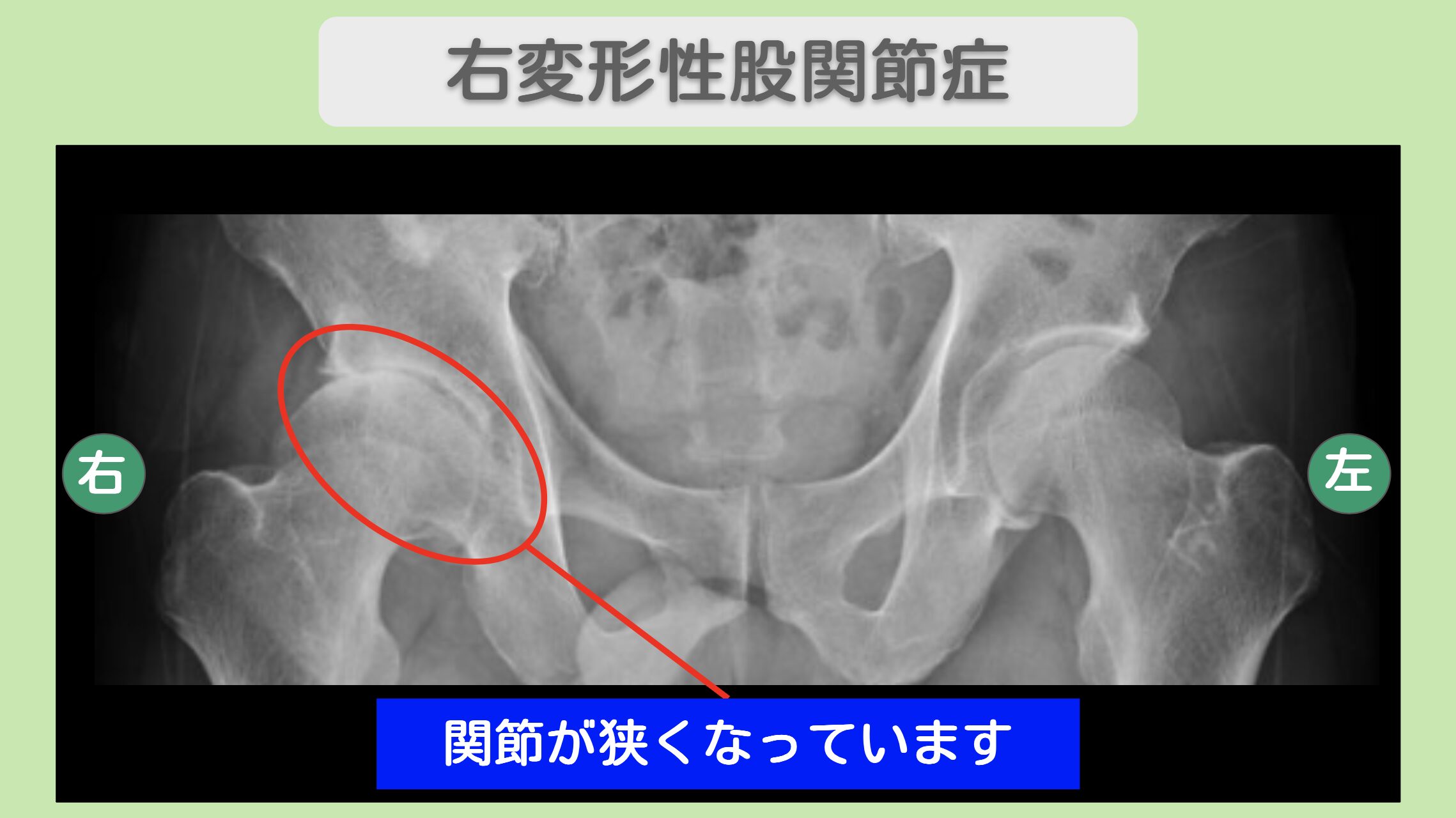 右変形性股関節症 60代男性のレントゲン所見