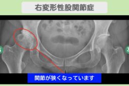 右変形性股関節症 50代女性のレントゲン所見