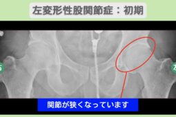 左変形性股関節症：初期