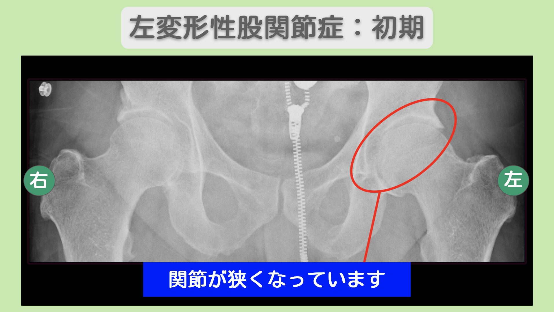 左変形性股関節症：初期