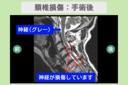 頚椎損傷:手術後