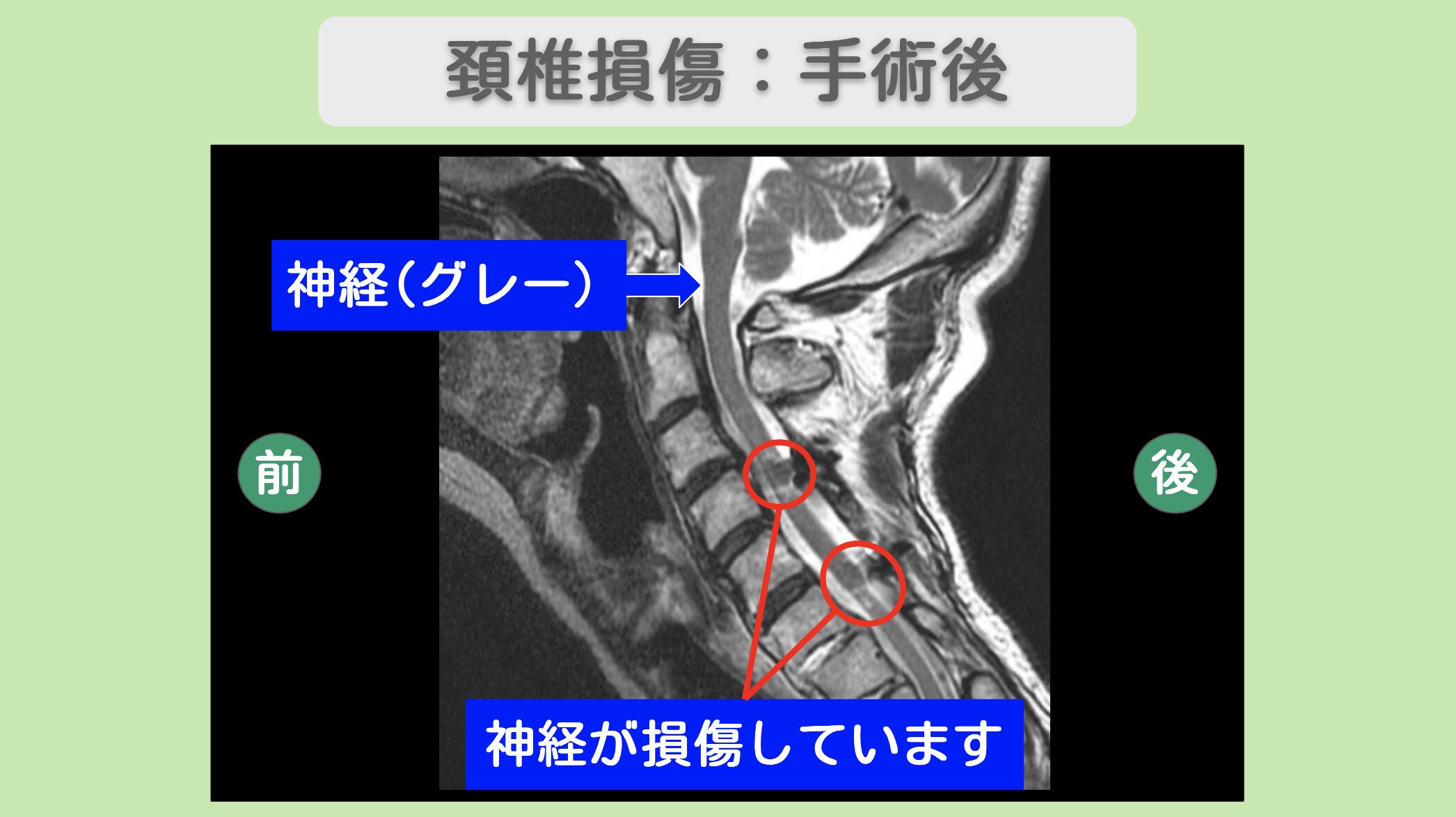 頚椎損傷:手術後