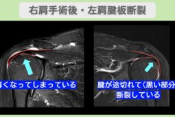 右肩手術後・左肩腱板断裂