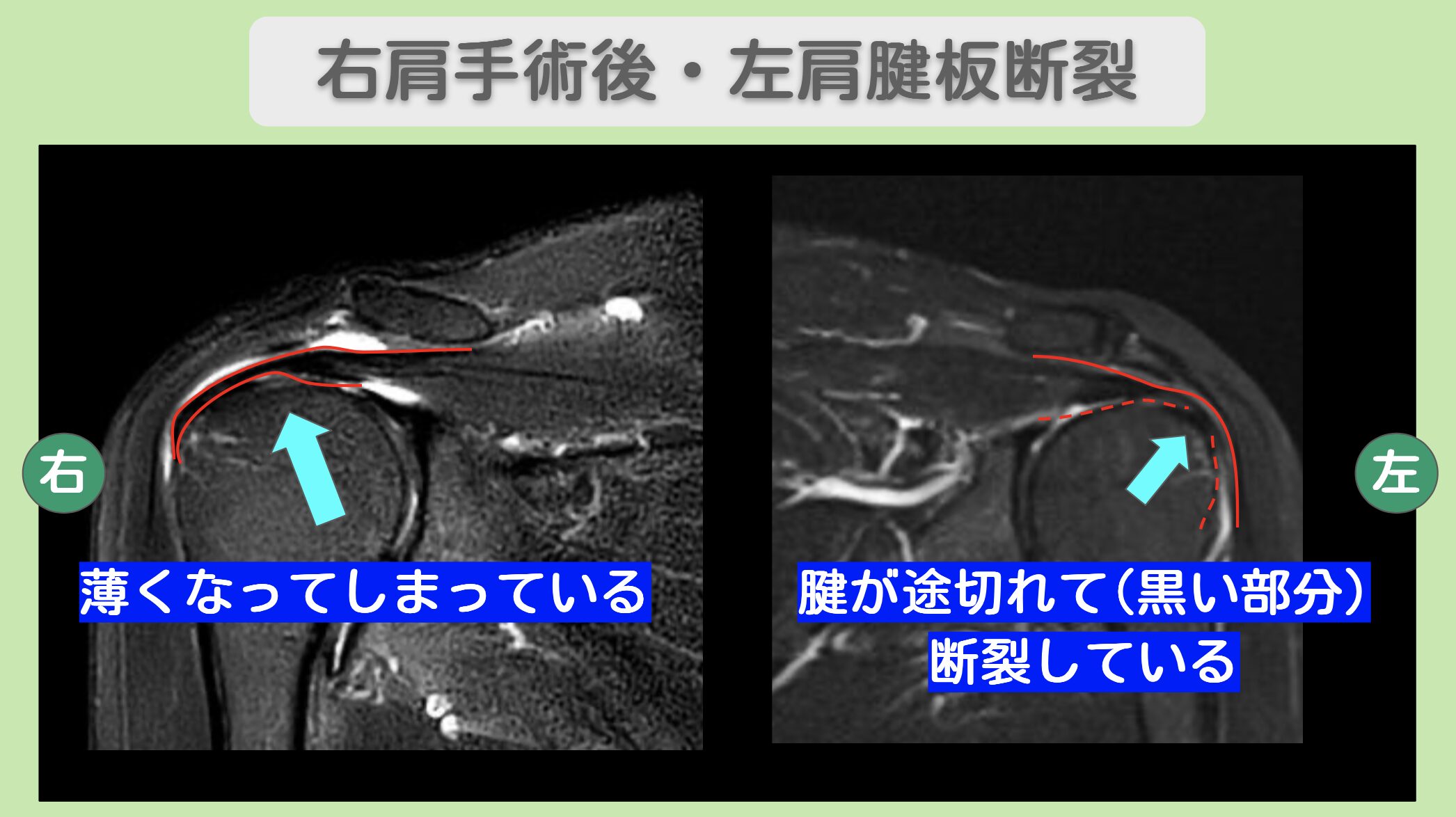 右肩手術後・左肩腱板断裂