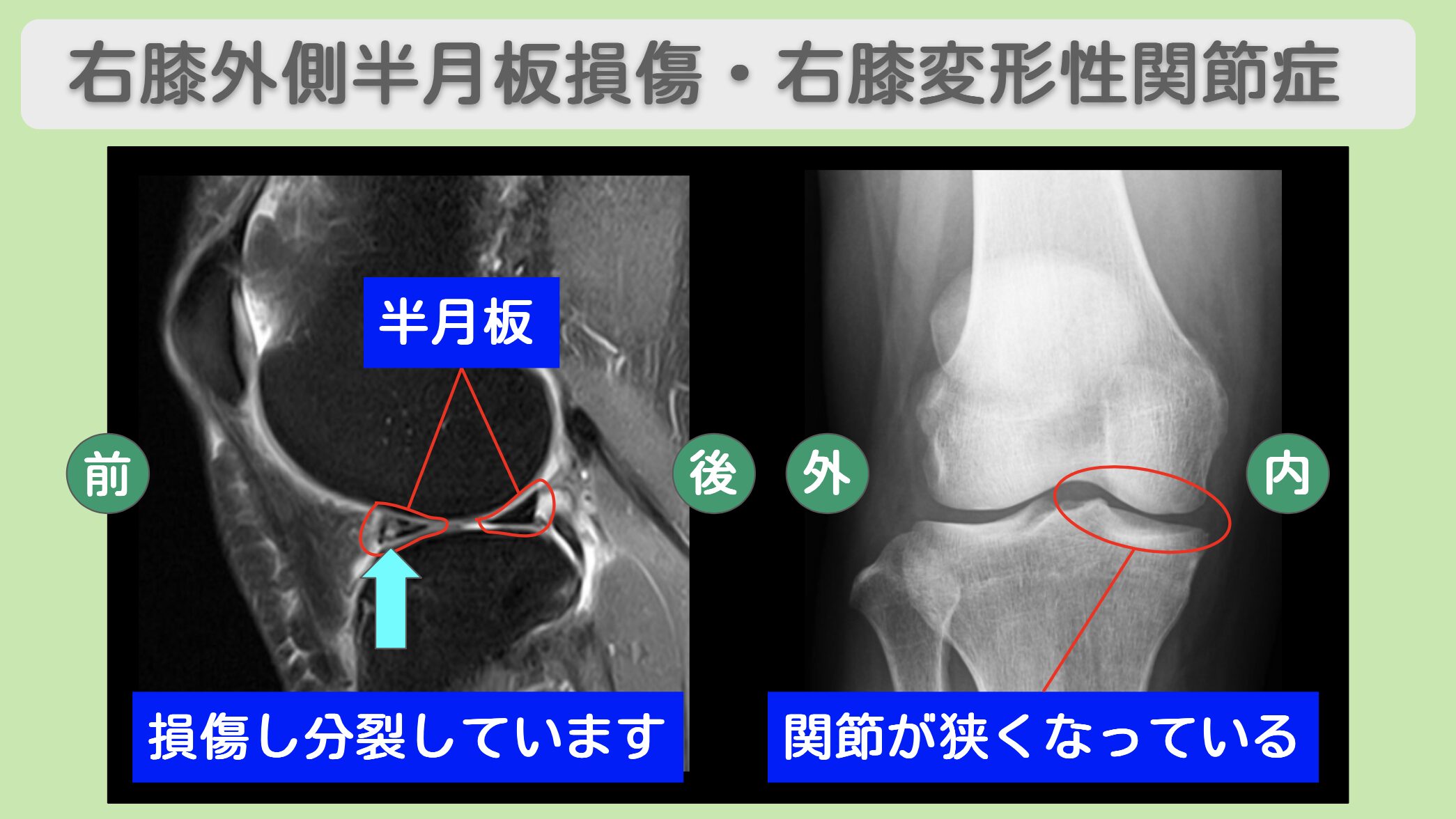右膝外側半月板損傷・右膝変形性関節症