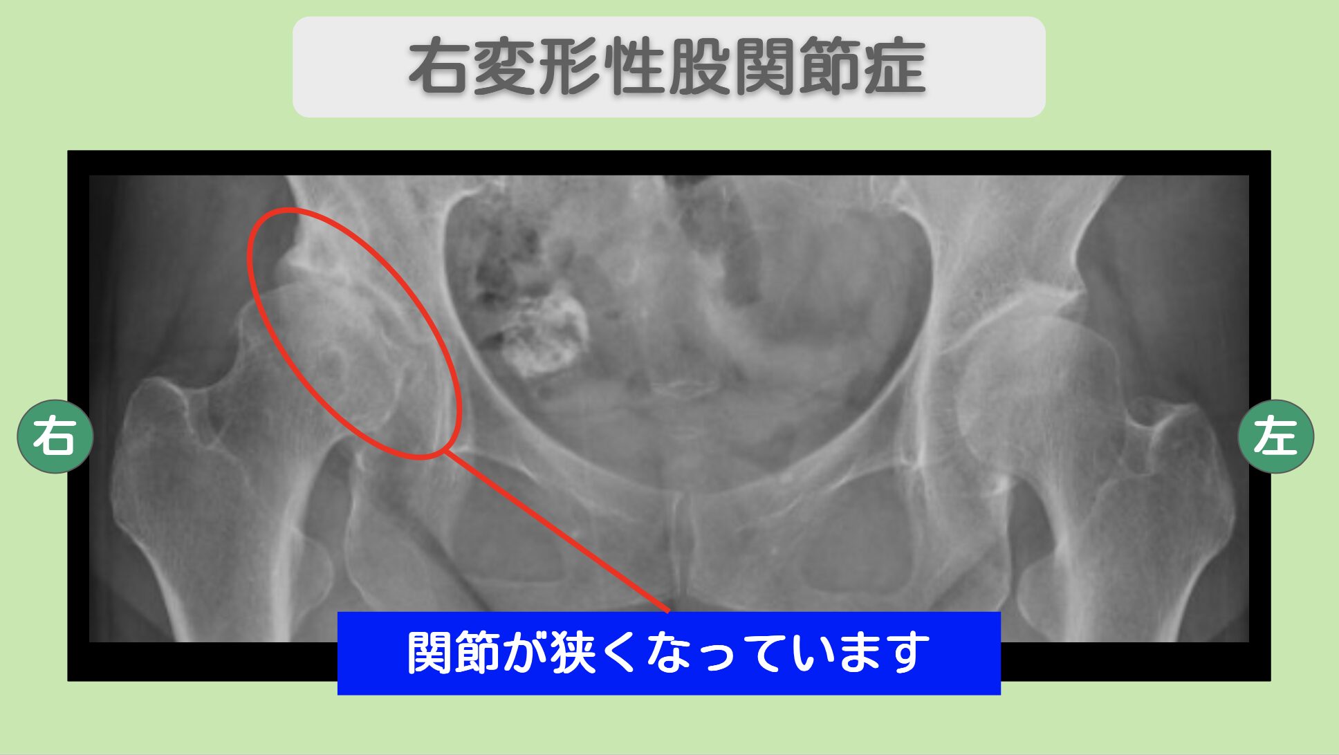 股関節(OA)の症例 東京院-1108