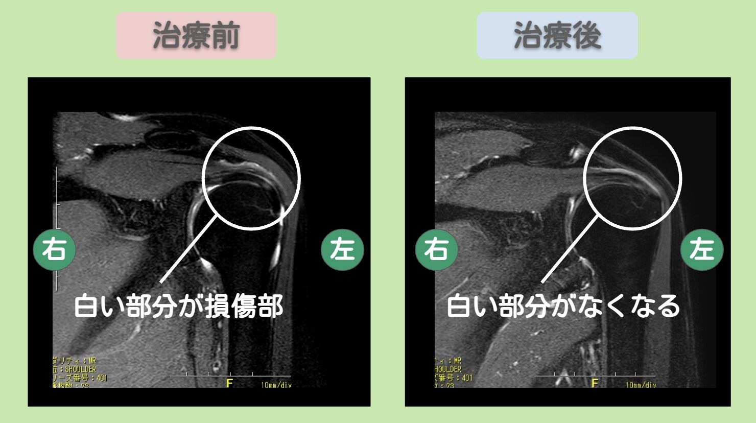 左肩腱板損傷の症例 大阪院-258