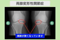 膝（OA）の症例 大阪院-305