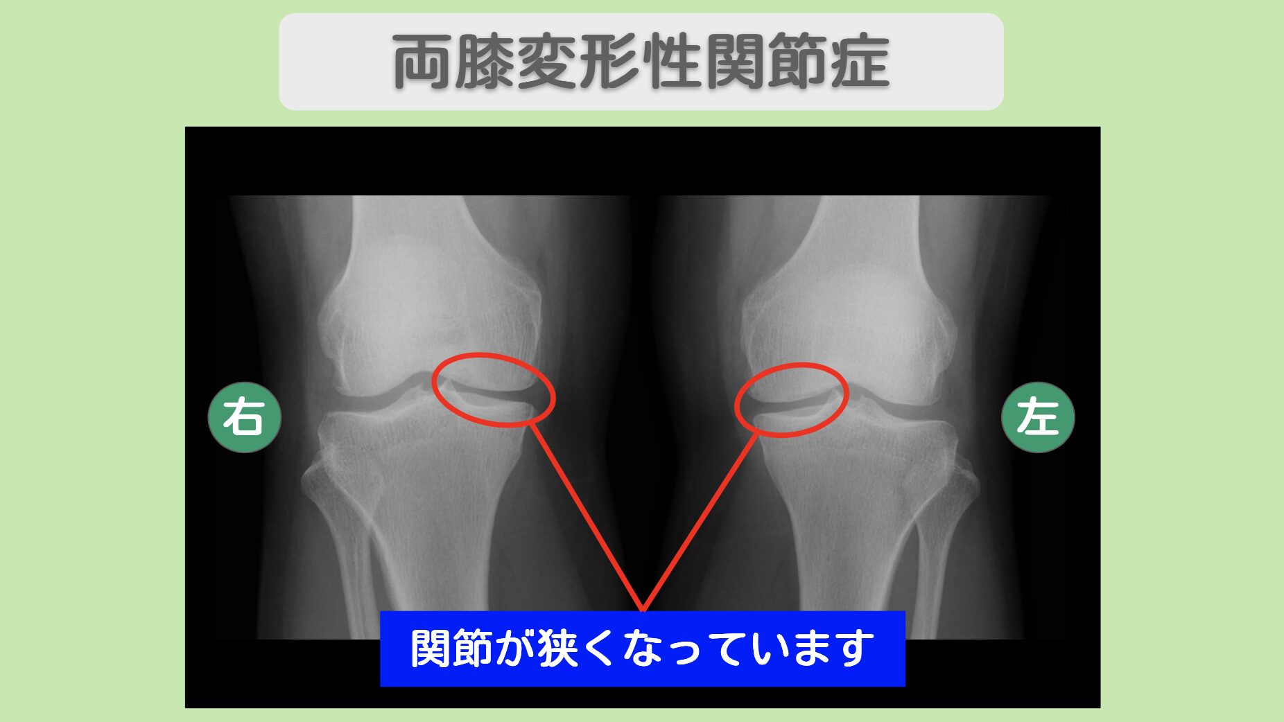 膝(OA)の症例 大阪院-305