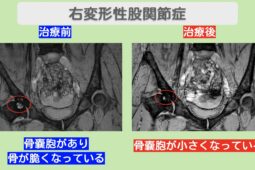 股関節(OA)の症例 大阪院-524