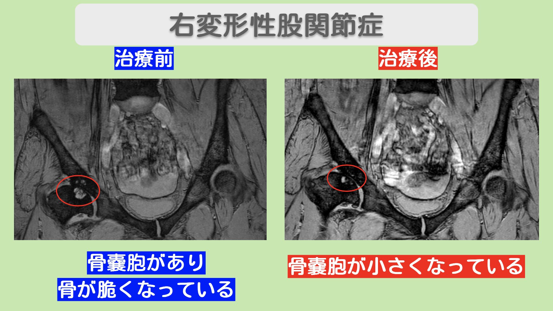 股関節(OA)の症例 大阪院-524