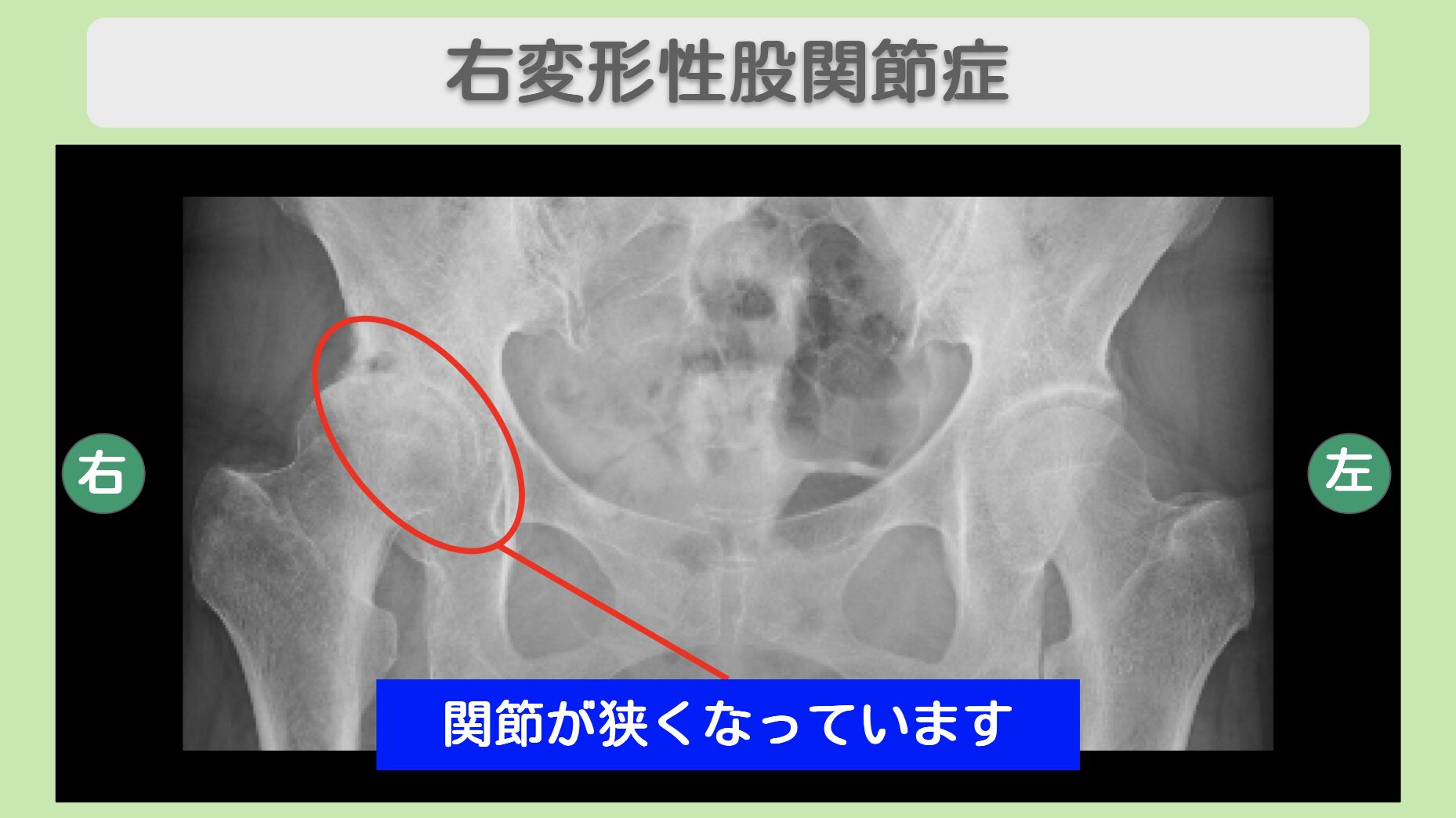 股関節(OA)の症例 大阪院-600