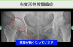 股関節(OA)の症例 大阪院-647