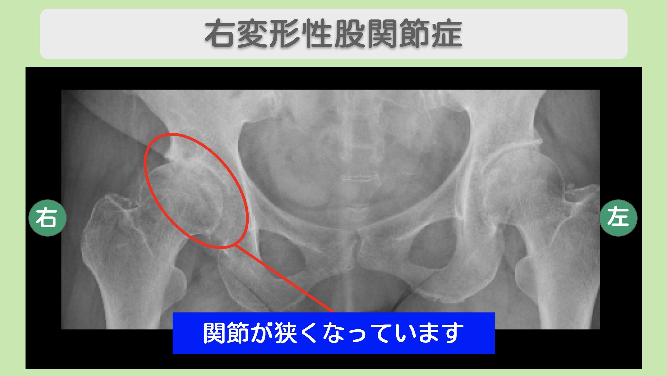 股関節(OA)の症例 大阪院-647
