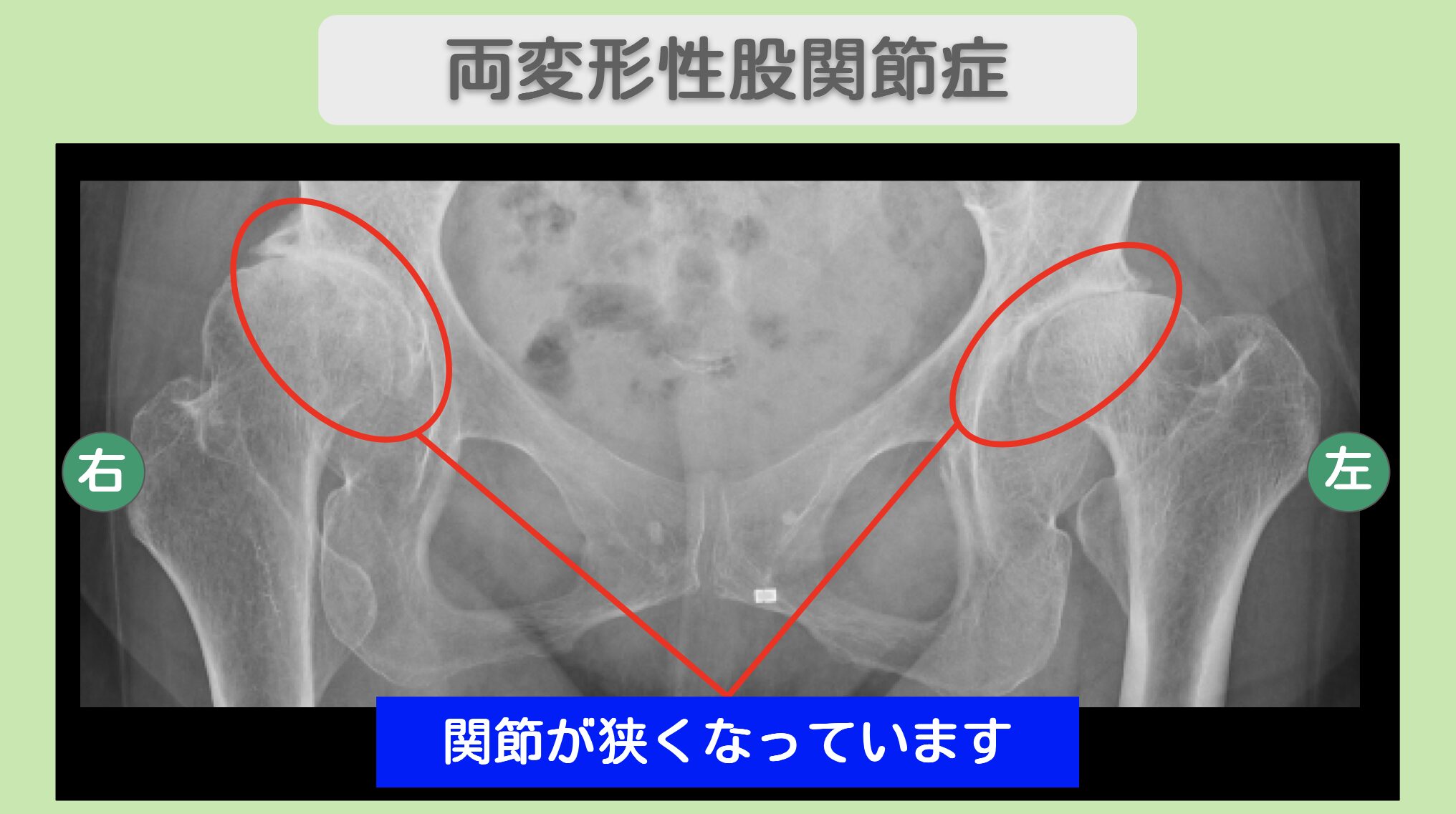 股関節(OA), 膝（OA）の症例 大阪院-685