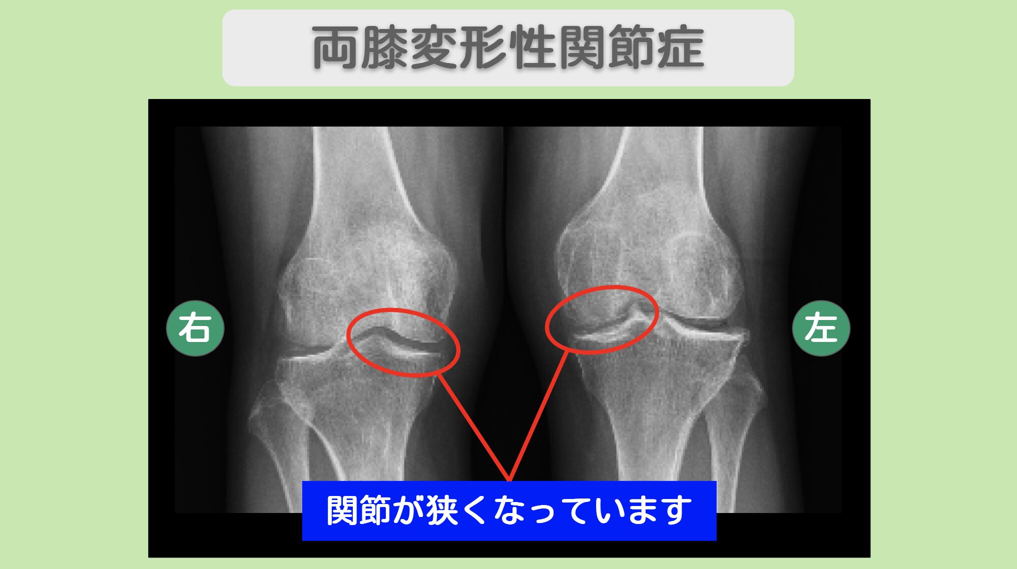 膝レントゲン所見