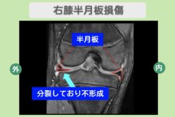 右膝半月板損傷
