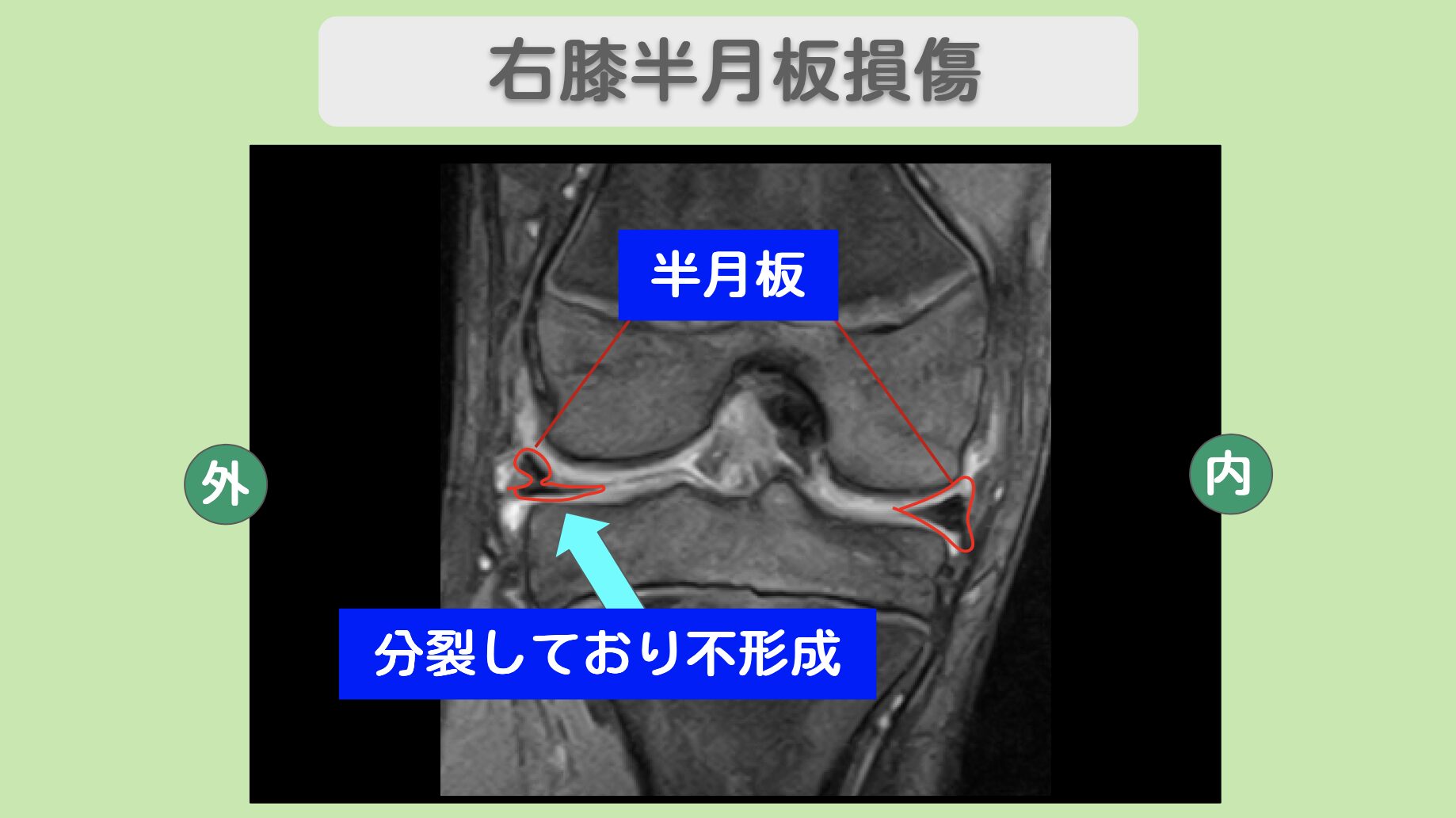 右膝半月板損傷