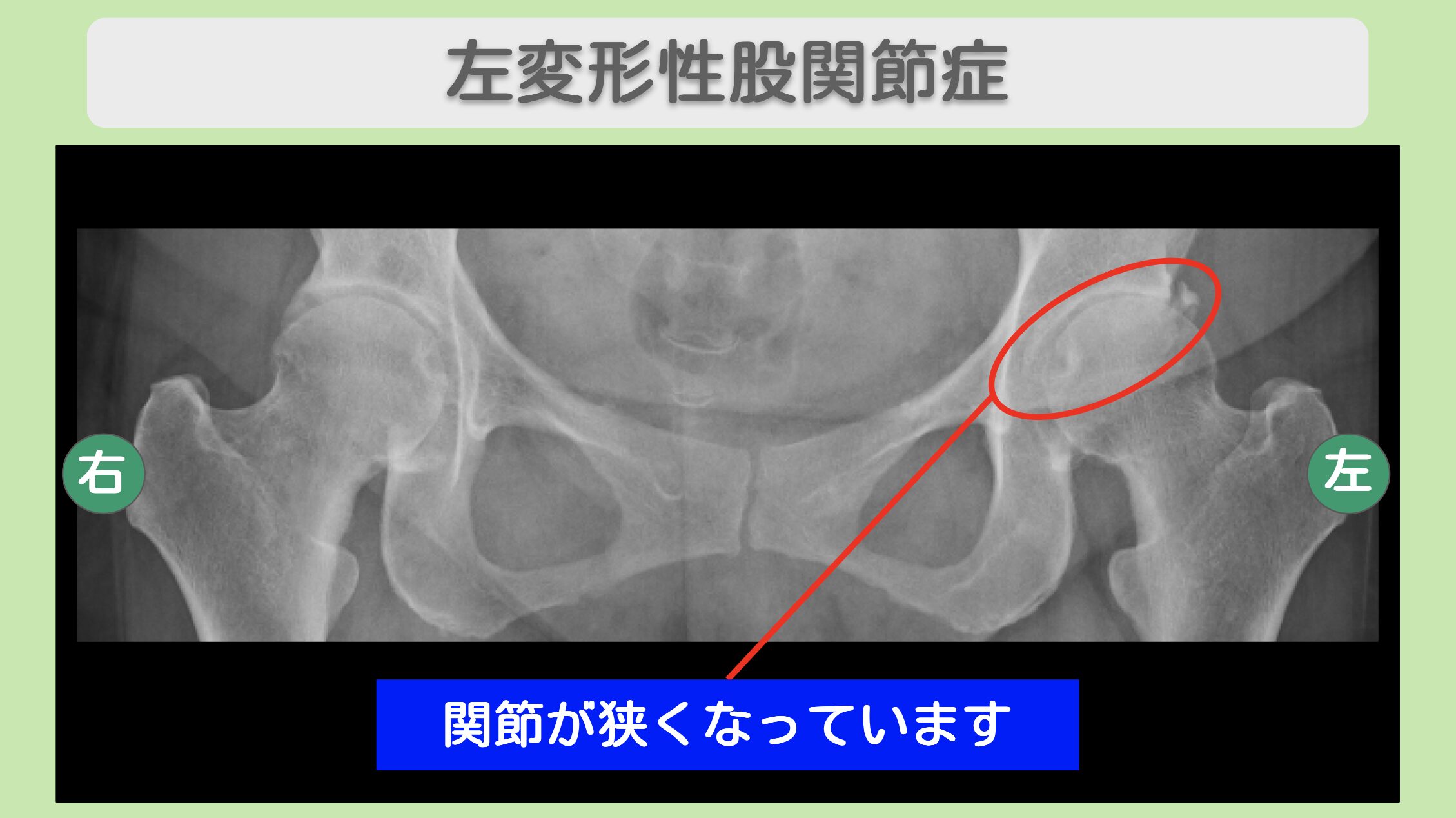 左変形性股関節症