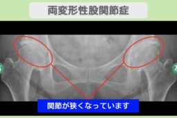 両変形性股関節症のレントゲン画像