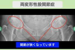 両変形性股関節症のレントゲン画像