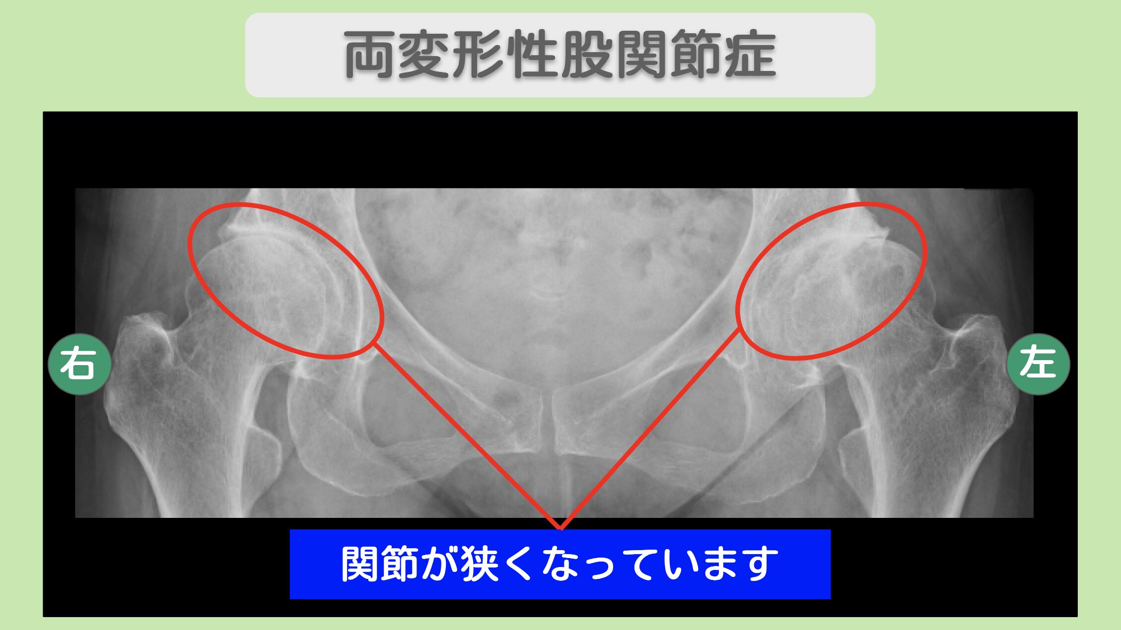 両変形性股関節症のレントゲン画像