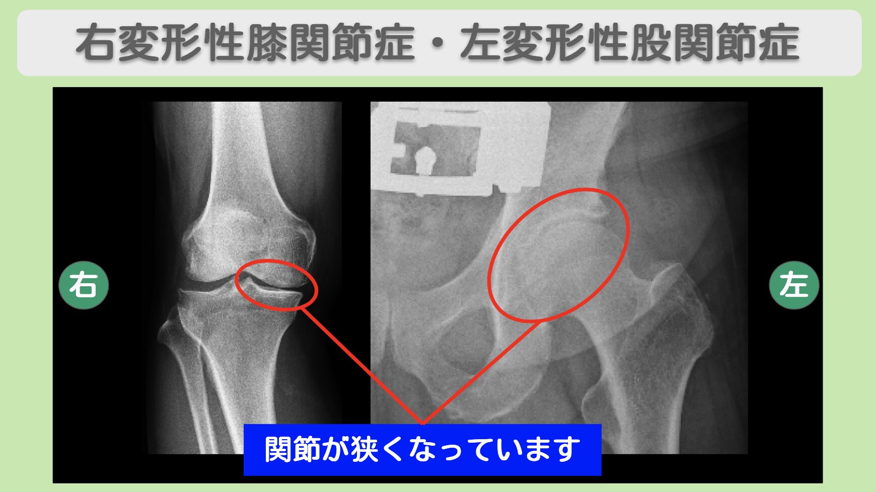 右変形性膝関節症・左変形性股関節症のレントゲン画像