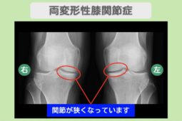 両変形性膝関節症のレントゲン所見