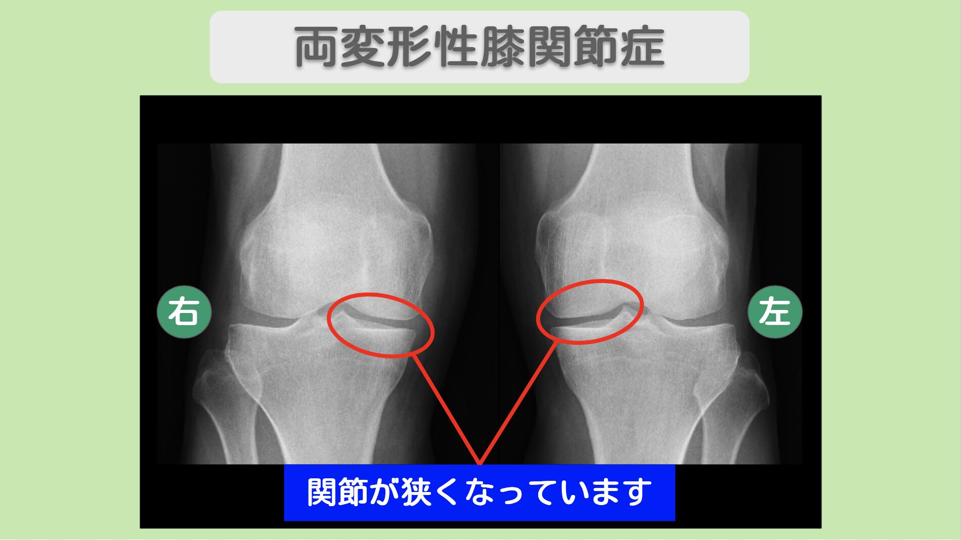 両変形性膝関節症のレントゲン所見