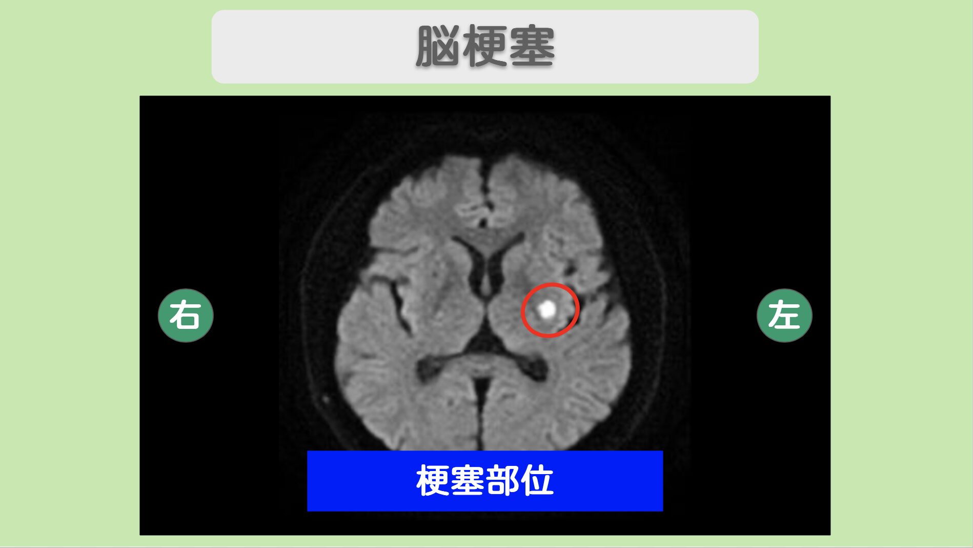 脳梗塞のMRI所見