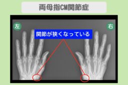 両母指CM関節症