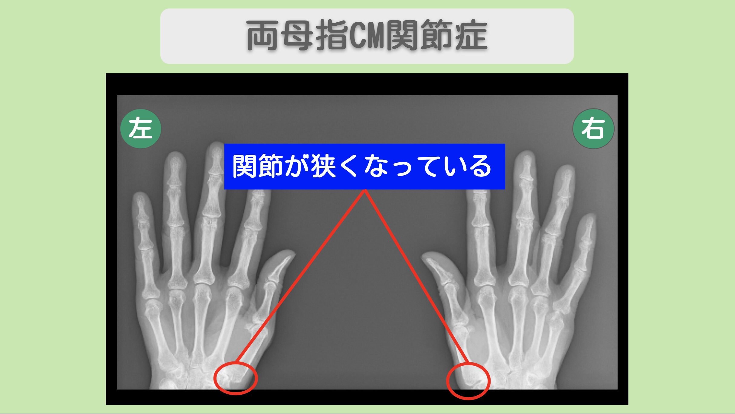 両母指CM関節症