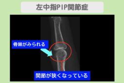 左中指PIP関節症のレントゲン所見（関節裂隙の狭小化と骨棘形成）