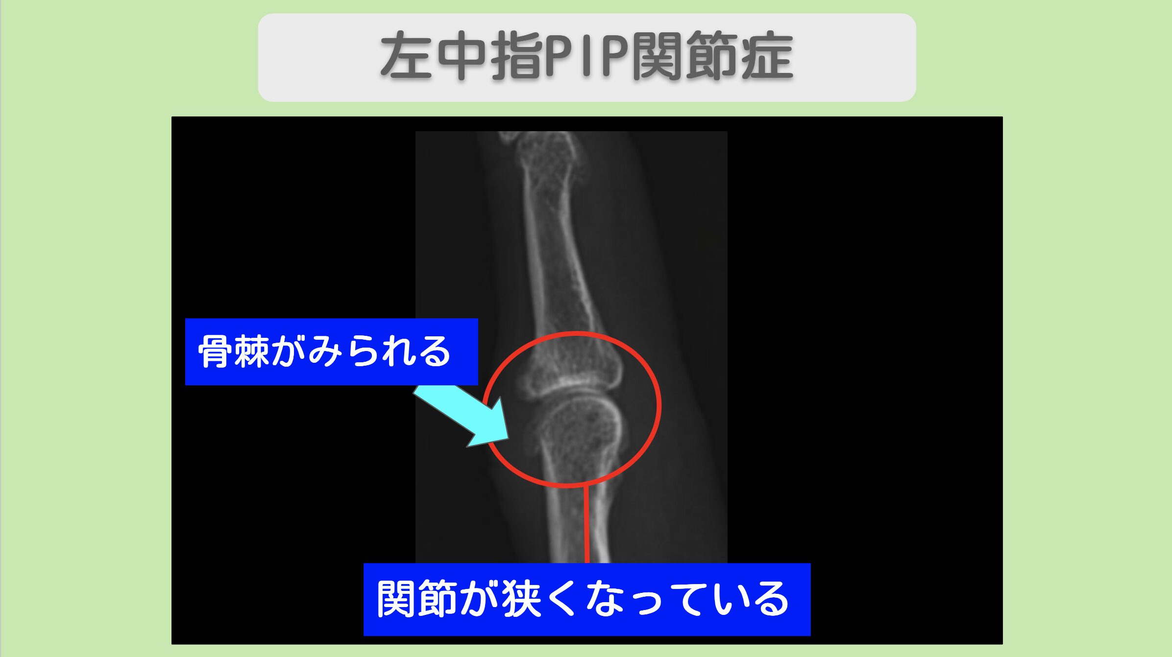 左中指PIP関節症のレントゲン所見（関節裂隙の狭小化と骨棘形成）
