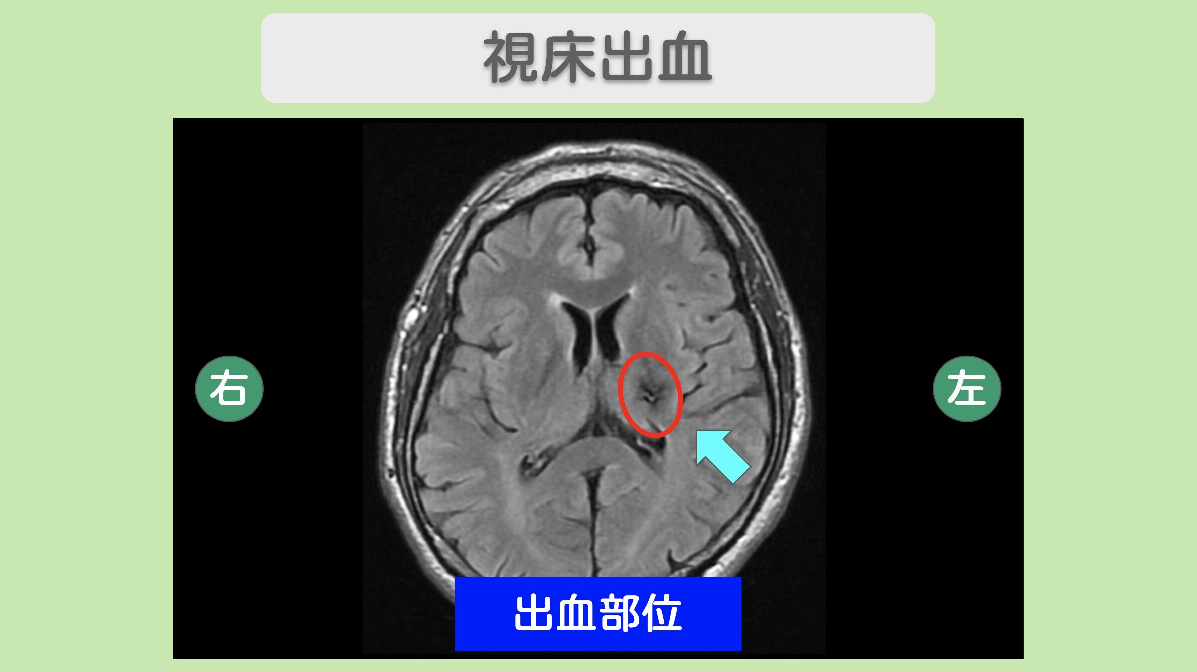 視床出血