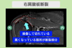 右肩腱板断裂