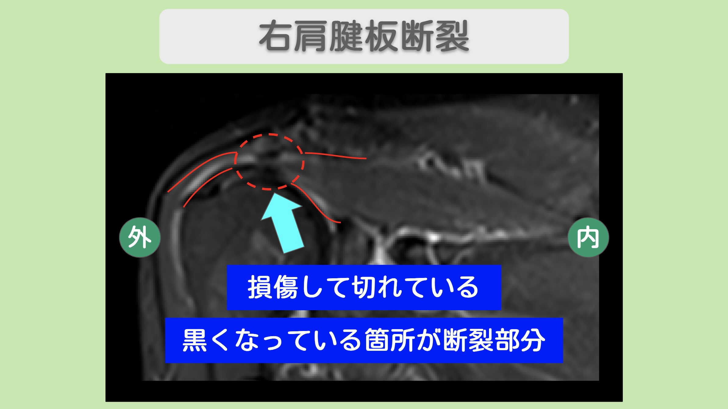 右肩腱板断裂