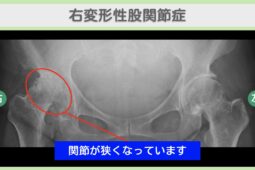 右変形性股関節症のレントゲン所見（関節が狭くなっている）